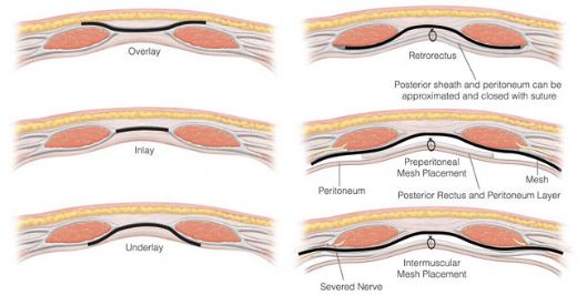 Karn Duvar Anatomisi